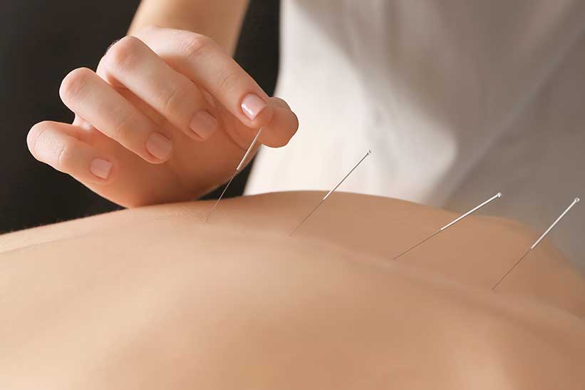 A persons back with fine acupuncture needles